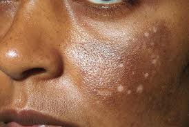 African American Skin and The Challenges You Face